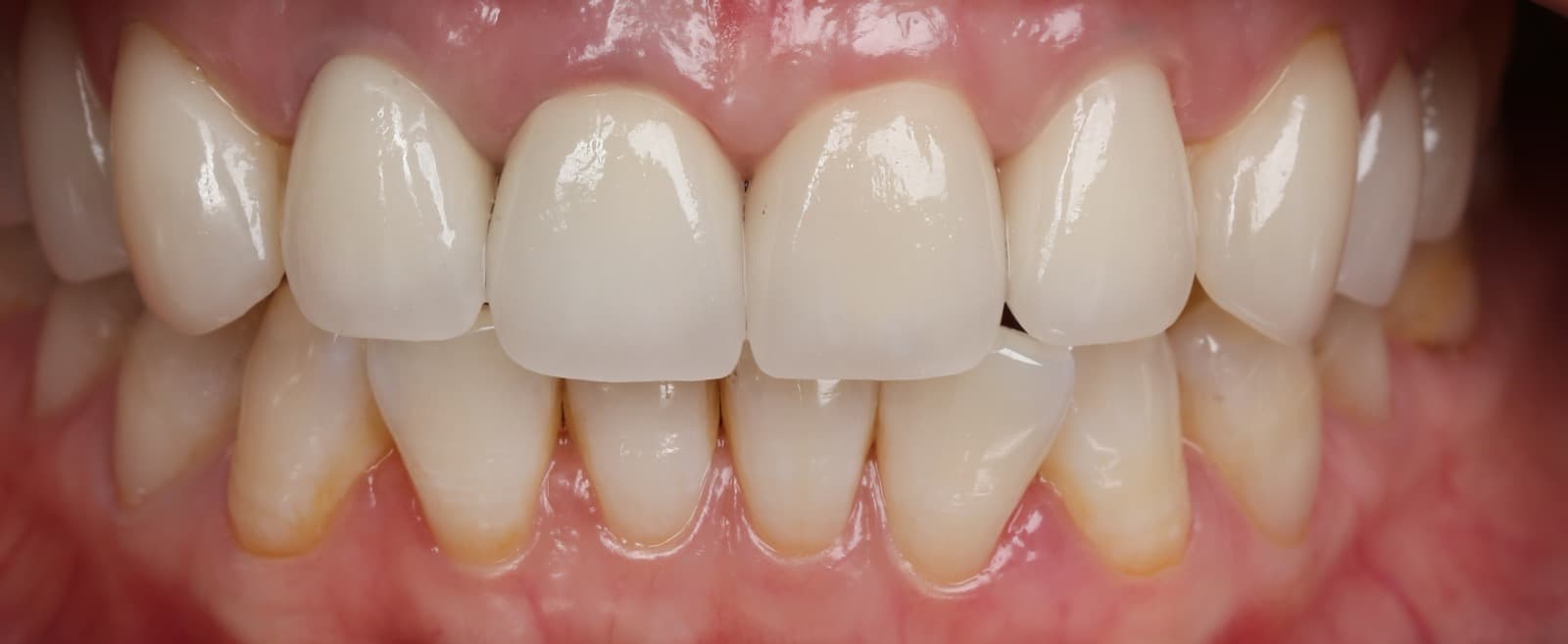 Thẩm mỹ Veneer răng sứ